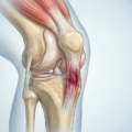 Tendinite rotulea: cause, sintomi e trattamento con onde d’urto e fisioterapia