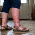 Gonfiore alle gambe e senso di pesantezza: cause, rimedi e quando agire
